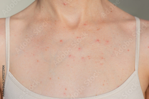 Close-up photo of a young woman suffering acne in the chest and neck. Skin diseases. Hormonal disorders. 