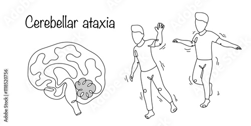 Cerebellar ataxia