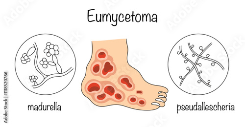 Eumycetoma photo