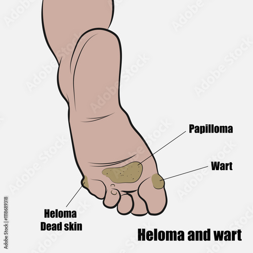 Difference between heloma and plantar warts.