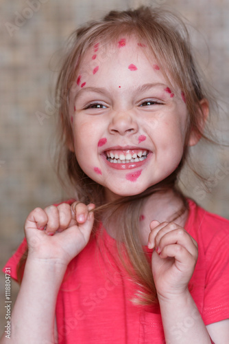 A little girl has chickenpox and her face is covered in red dots and spots, she is laughing, close-up portrait. Childhood illness.