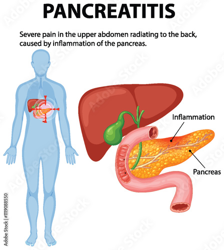 Understanding Pancreatitis and Its Symptoms