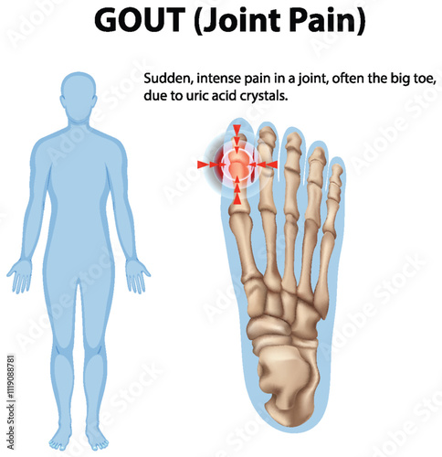 Understanding Gout and Joint Pain