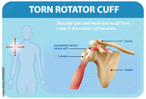 Understanding Torn Rotator Cuff Injuries