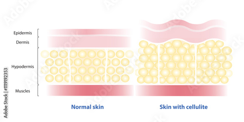 Comparison of normal skin and skin with cellulite vector illustration isolated on white background. The fat cells enlarged, connective tissue stretched. The skin dimpling, looks like orange peel.