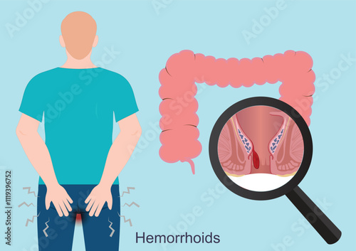 Hemorrhoids or piles are common irritations.