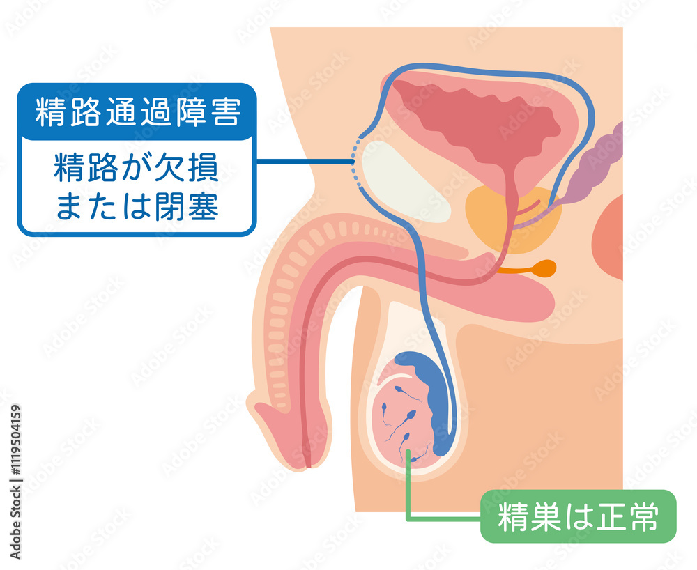 Fototapeta premium 精路通過障害 精路が欠損または閉塞 男性不妊