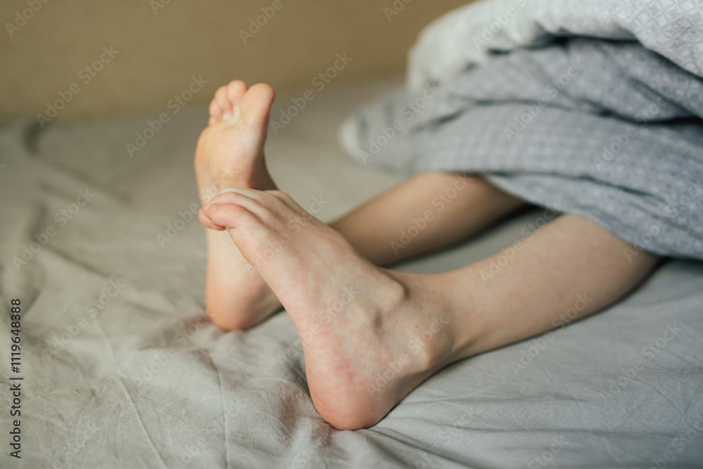 Close up of Child's legs with many red spot. A sick child with skin ...