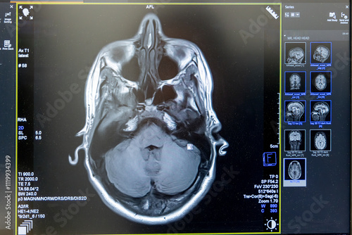 MRI brain scan. Medical, science and education mri brain. Magnetic resonance. MRI blood vessels brain, cerebrovascular disease. photo