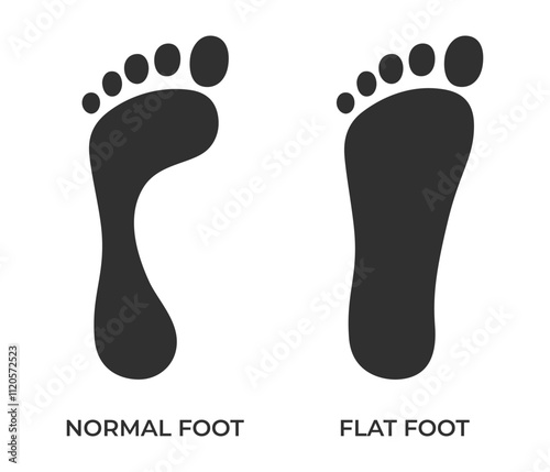 Foot deformation. Normal and flat foot prints. Medical or orthopedic theme infographic. Vector illustration in flat style isolated on white background.