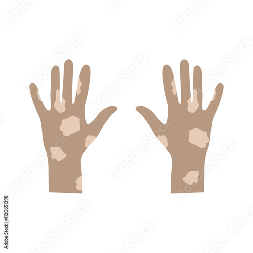 the hands of people with leprosy , International Leprosy Day