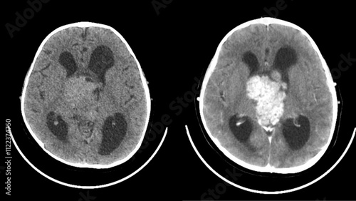 Bild auf Leinwand ependymoma , intraventricular mass head ct scan