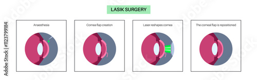 LASIK eye surgery