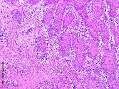 Photomicrograph of chronic osteomyelitis under a microscope in a pathology laboratory photo