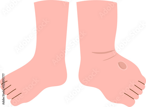 Injury Illustration. Swollen foot