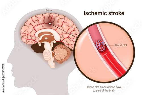 Ischemic stroke vector. Blood clot blocks blood flow
to part of the brain. Thrombosis. Brain tissue death.