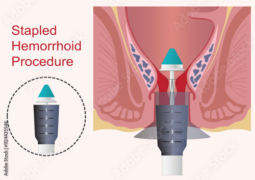 Stapled hemorrhoidopexy procedure is a type of surgery