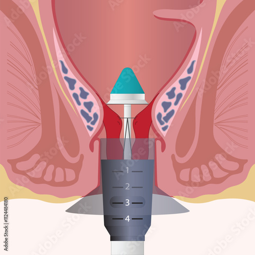 Stapled hemorrhoidopexy is a surgical procedure.