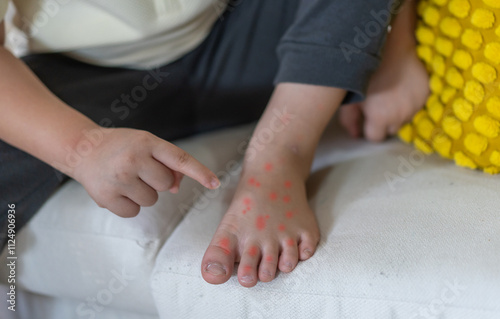 Asian boy showing red rash and blisters on foot symptoms of hand foot mouth disease skin irritation, childhood health condition infectious disease awareness medical care and prevention concept photo