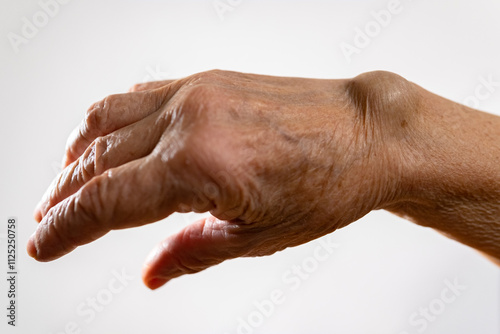 Ganglion cyst on the arm of an elderly woman on a white background