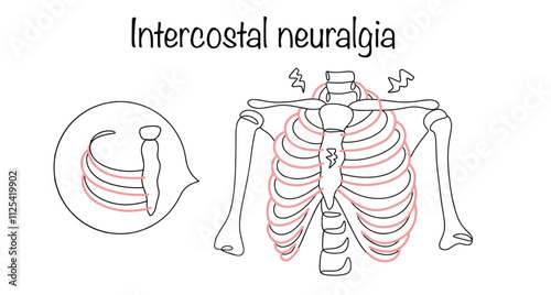 Intercostal neuralgia