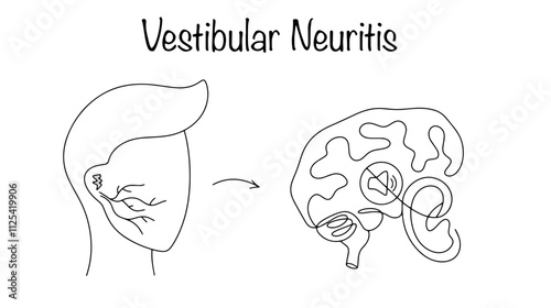 Vestibular Neuritis