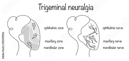 Trigeminal neuralgia