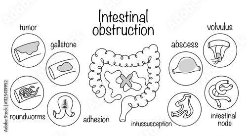 Intestinal obstruction