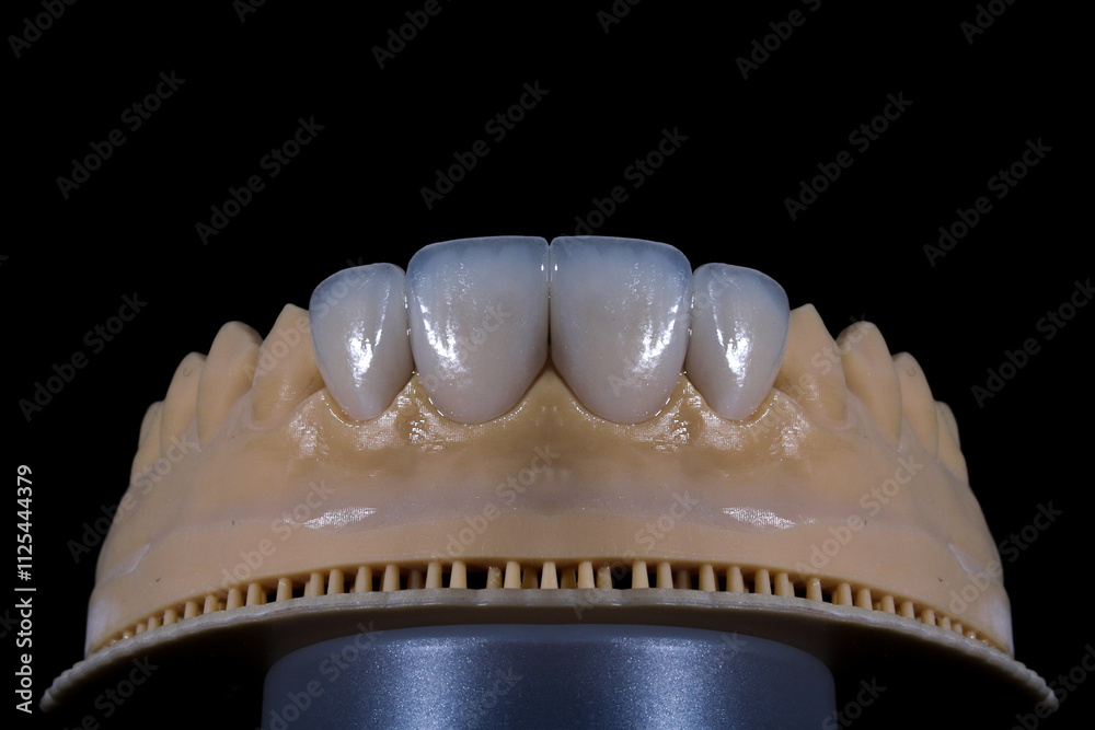 Dental porcelain crowns. Dental laminate veneers in smile design treatment in dentistry. Smile makeover.
Dental porcelain crowns. Dental laminate veneers in smile design treatment in dentistry. Smile makeover.