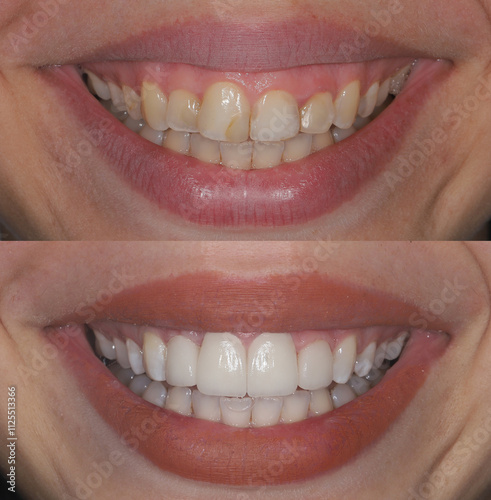 A beautiful woman with full lips undergoes a smile design treatment using E-max and zirconium porcelains to replace discolored and decayed teeth. The process includes dental before-and-after