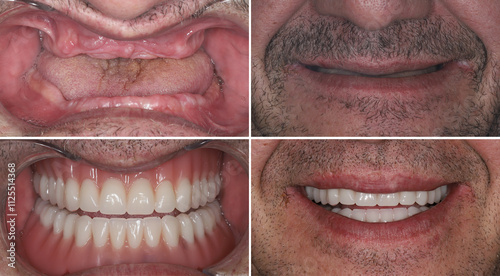 In dentistry, dental implant treatment involves placing a full arch dental prosthesis on 4 implants. The process includes dental before-and-after images and X-ray images. smile makeover.