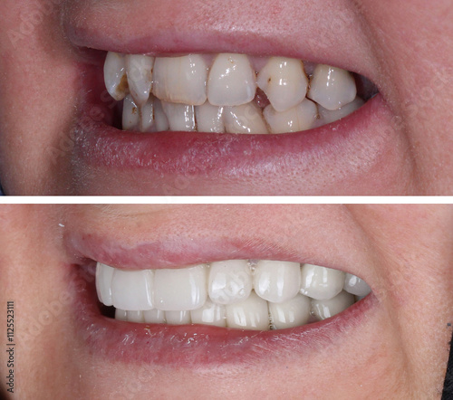 In dental aesthetic dentistry, smile design treatment with laminate veneers and zirconium crowns. Smile makeover dental before and after.
