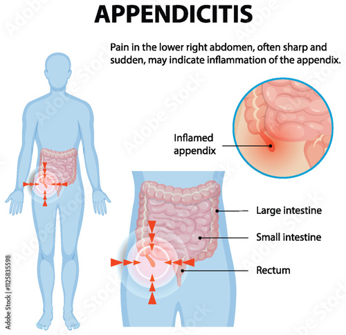 Understanding Appendicitis and Its Symptoms