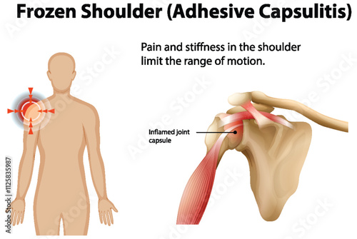 Understanding Frozen Shoulder Anatomy