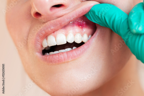 A close-up of a doctor in green gloves examining the gums of a young woman suffering from an acute stomatitis ulcer.
