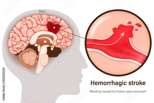 Hemorrhagic stroke vector. Bleeding caused by broken open aneurysm. Cerebral hemorrhage. Human brain anatomy structure.