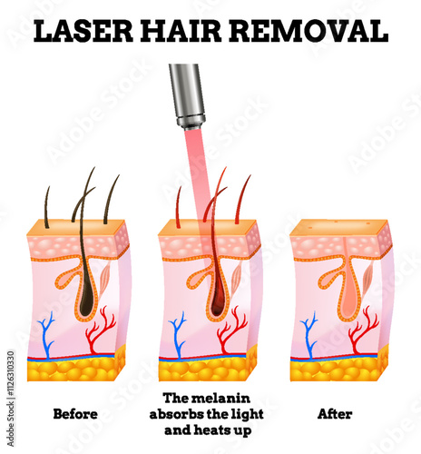 Laser hair removal procedure with concentrated beam of light on the skin. Skin layers, laser affects on body hair. Face hair removal icon for cosmetology or skincare. Medical science concept