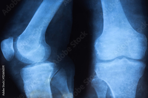 Knee joint x-ray. Diagnostic of Knee bone pathology, detected, such fracture, destruction, osteoarthritis. Assessing ligaments, cartilage, and identifying issues like tears or inflammation. photo