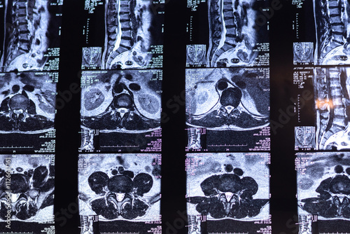 Magnetic resonance image of human spine. MRI of lumbar spine. Pinched discs of spine and nerves. Intervertebral disc herniation.