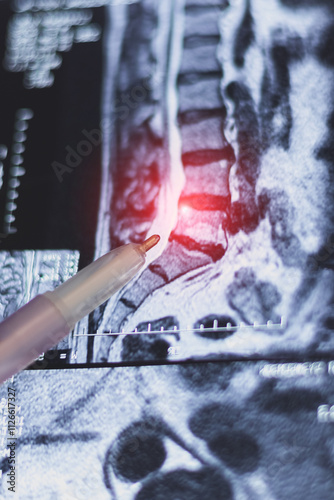 Doctor learn Vertical Magnetic resonance image of human spine. MRI of lumbar spine. Pinched discs of spine and nerves. Intervertebral disc herniation.