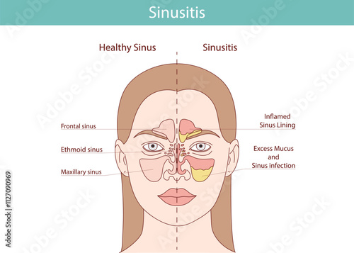 Flat image of sinusitis and sinusitis. Infections, inflammations, nasal diseases.