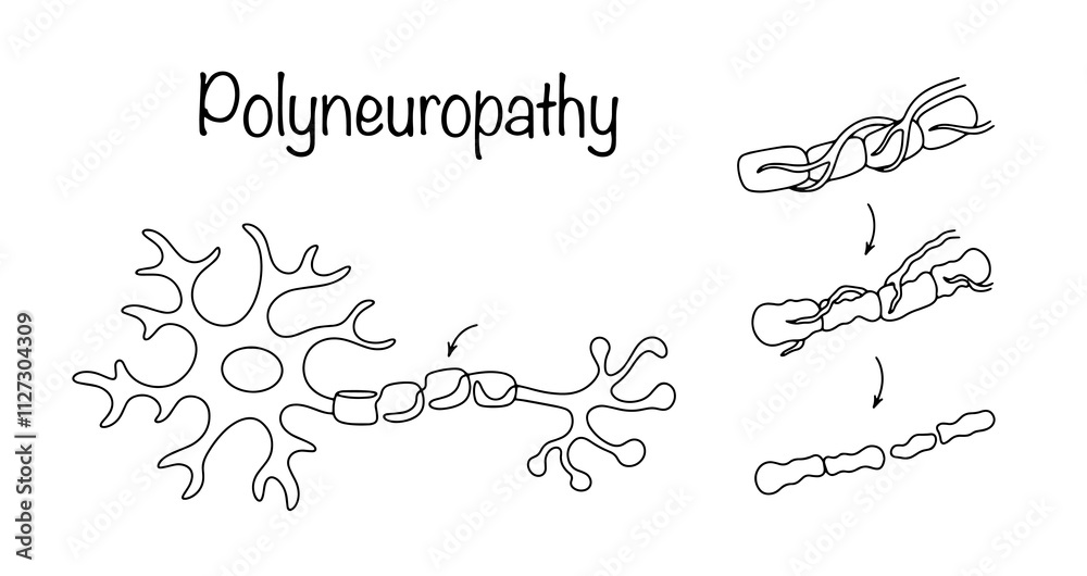 Polyneuropathy Polyneuropathy