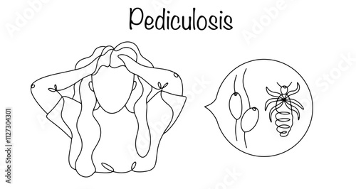 Pediculosis