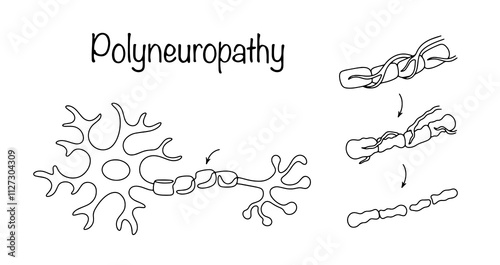 Polyneuropathy