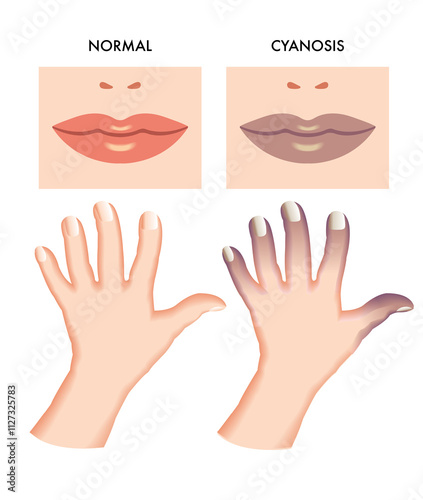 Medical illustration of symptoms of cyanosis