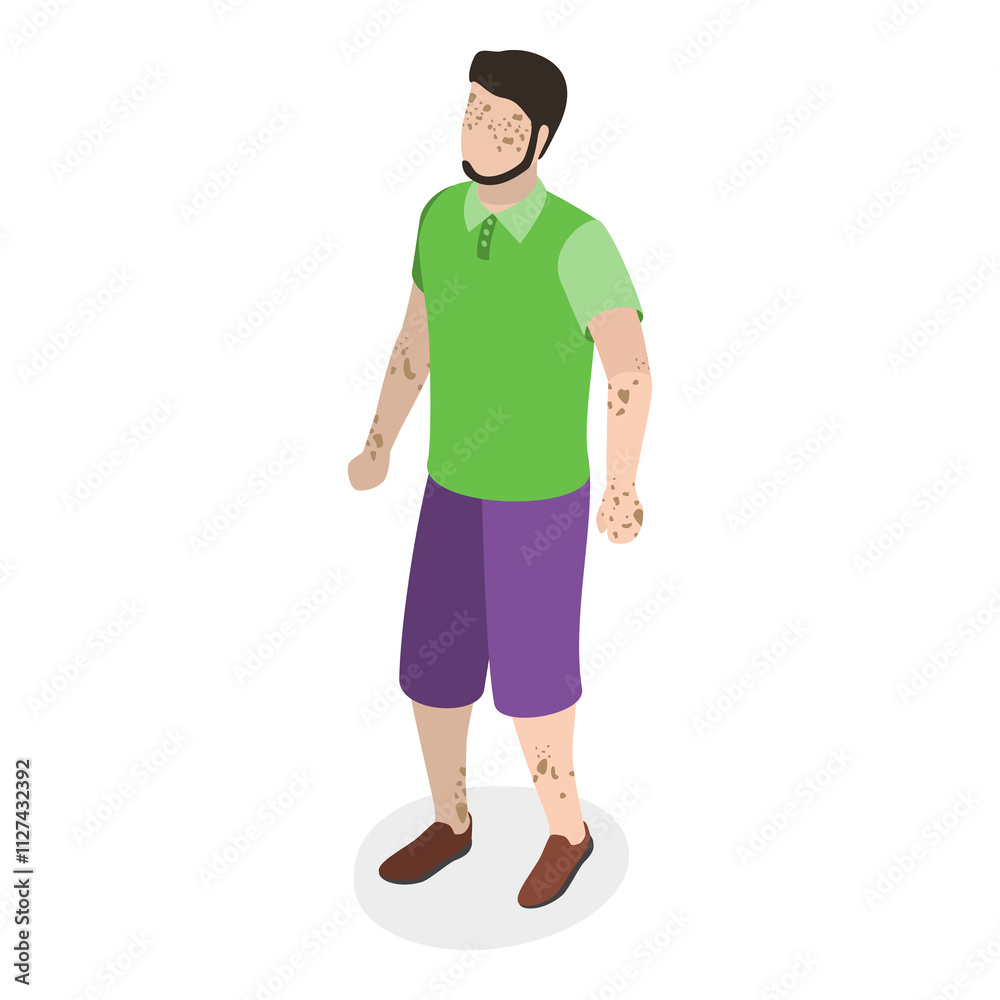 3D Isometric Flat Set of Happy People with Vitiligo. Item 2 3D Isometric Flat Set of Happy People with Vitiligo. Item 2
