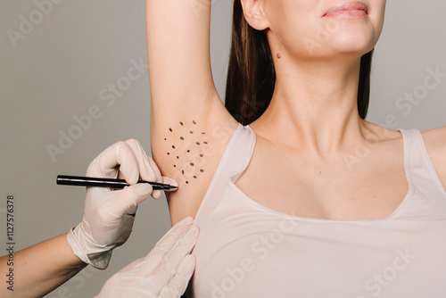 Cosmetologist is marking dotes before injecting woman's armpit, closeup. Treatment of hyperhidrosis. Markup skin for hyperhidrosis treatment in the clinic.