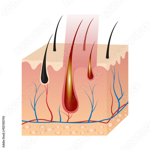 Laser Hair Removal Procedure After Exposure To Laser Light. Infographics Of Hair Follicle Influence
