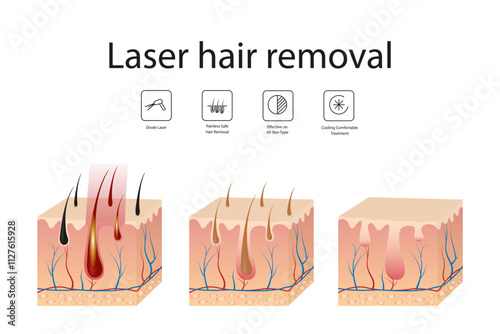 Hair follicle laser examination. Laser hair removal procedure. Step-by-step hair removal method.