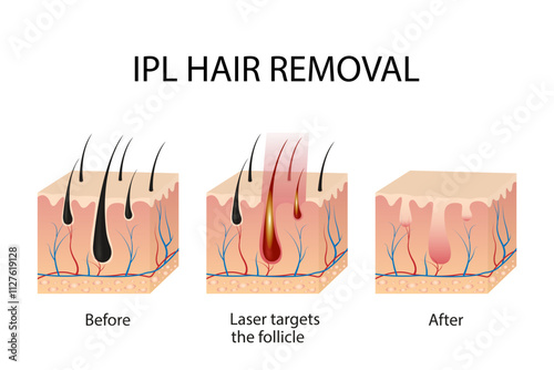 Hair follicle laser examination. Laser hair removal procedure. Step-by-step hair removal method